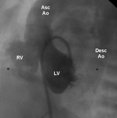 Pulmonary Atresia With Ventricular Septal Defect. 