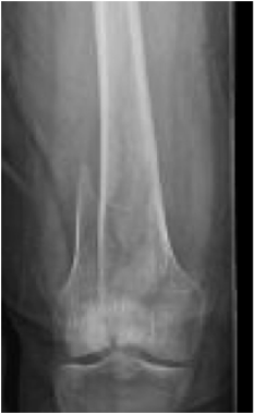 Radiograph of an intra-articular distal femur frac