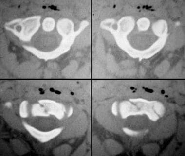 Computed tomography scans of odontoid type 3 fract