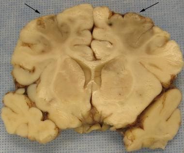 Bilateral acute infarctions of the frontal lobe ar