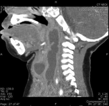 Saggital CT reveals a large lymphatic malformation