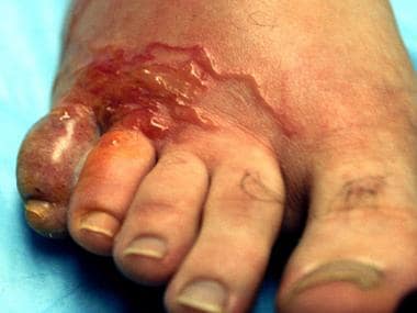 Cutaneous larva migrans involving the foot with er