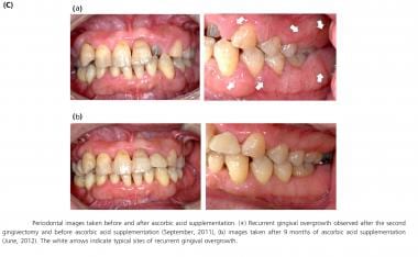 Periodontal images taken before and after ascorbic
