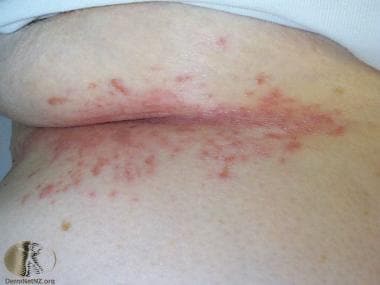 Search Results: Axilla, Rash or multiple lesions