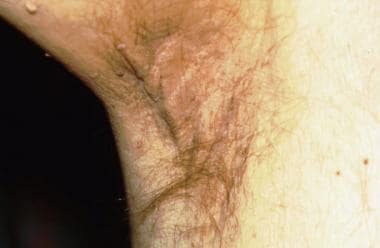 Acanthosis nigricans (AN) in a patient with pancre