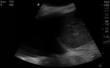 Ultrasound image of a large pleural effusion. Imag