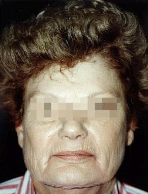 Before: Female patient with advanced dermatohelios