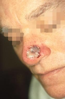 Early hematoma under full-thickness skin graft rep