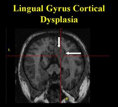 Cortical dysplasia in the lingual gyrus extending 
