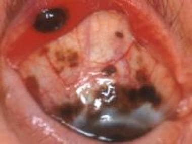 An aggressive conjunctival melanoma with lid invol