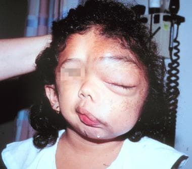 Massive facial deformity in a young girl severely 