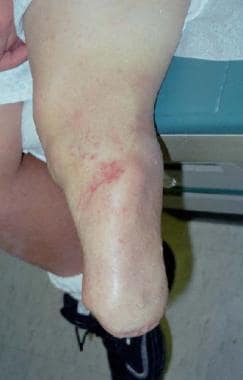 Below-knee amputation for tibial pseudarthrosis. 