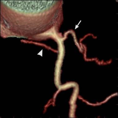 Conus and sinoatrial node arteries: Volume-rendere