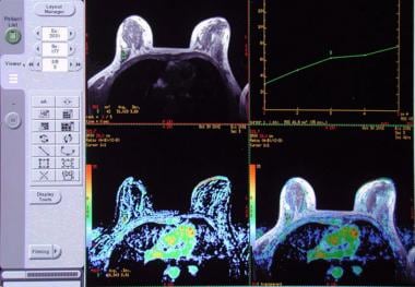 Diffusion-weighted imaging of breast begins to come of age