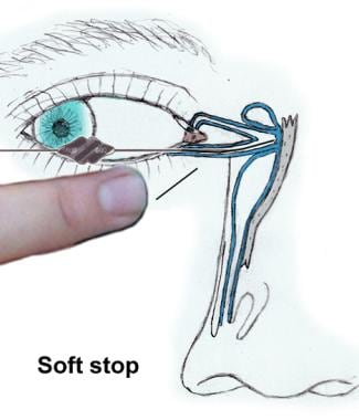 "Soft stop" occurs when distal progress of probe i