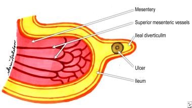 Ileal (Meckel) diverticula and other remnants of y