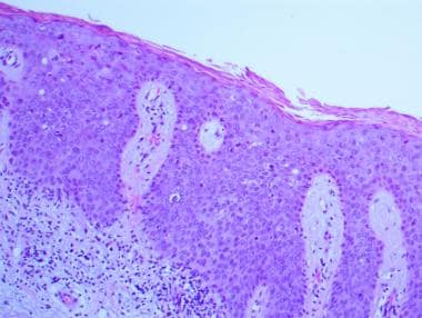 Pathology of cutaneous squamous cell carcinoma and