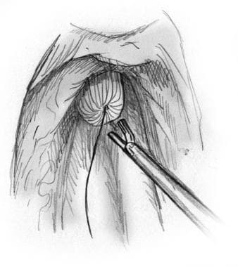 Minimally invasive esophagectomy. Dissection of es