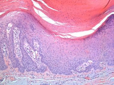 A hypertrophic/hyperplastic actinic keratosis from