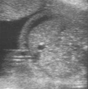 Ultrasound images of hydrops. Transverse image of 