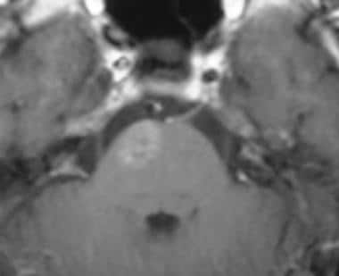 Axial contrast-enhanced T1-weighted MRI obtained t