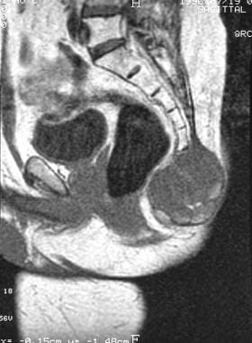 Coccygeal chordoma. Sagittal T1-weighted magnetic 