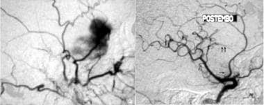 Embolization may be the only treatment required in