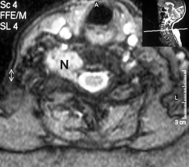 T2-weighted transaxial MRI in a 66-year-old woman 