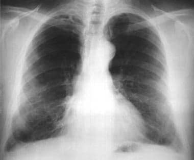 Asbestosis. Posteroanterior chest radiograph revea