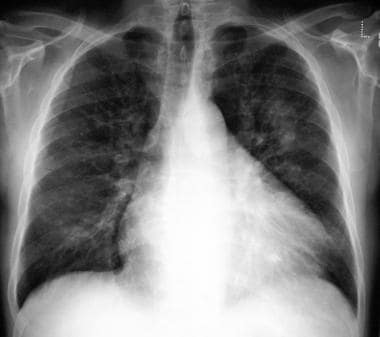 Chest radiograph in a 54-year-old man with asthma 