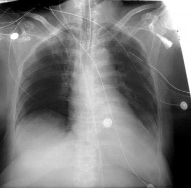 Supine chest radiograph shows a misplaced jugular 