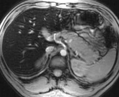 T2-weighted gradient echo axial image in a patient