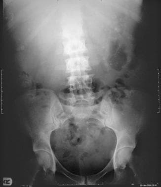 Plain radiograph of the kidney, ureters, and bladd