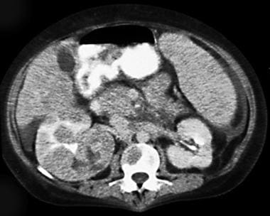 Computed tomography scan in a 36-year-old woman. T