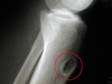 Lateral radiograph of the tibia of a 36-year-old m