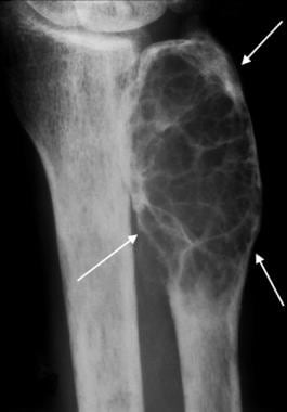 Anteroposterior radiograph of the distal forearm i