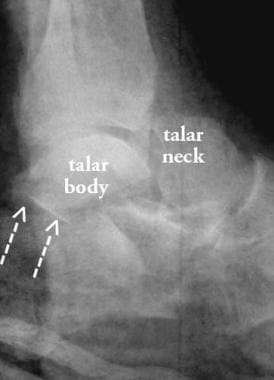 Hawkins type III fracture of the talar neck, later