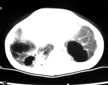 CT image of the bases of the lungs showing an unus