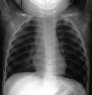 Chest radiograph depicts deviation of the trachea 