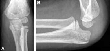 Olecranon fracture. (A) On the anteroposterior vie