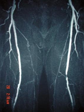This magnetic resonance angiogram (MRA) of the low