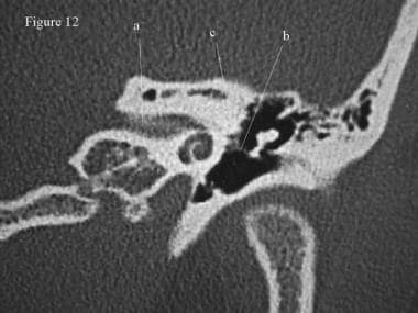 CT scan, temporal bone. This section demonstrates 
