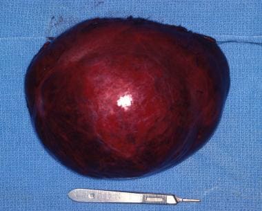 Gross image of the mesenchymal hamartoma specimen 