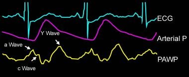 Large V waves in a case of mitral regurgitation. 