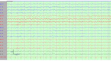Electroencephalogram demonstrating right temporal 