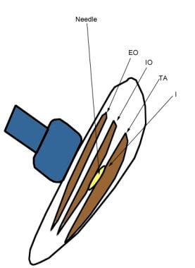 Anatomy of the transversus abdominis plane (TAP). (A) Diagram shows