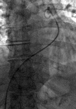 Tip of catheter in the main pulmonary artery. 