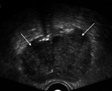 Axial image of a prostate. White arrows show the a