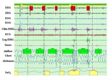 Compressed overnight polysomnography tracing of a 