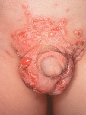 Bullous lesions on the genital area in a child wit